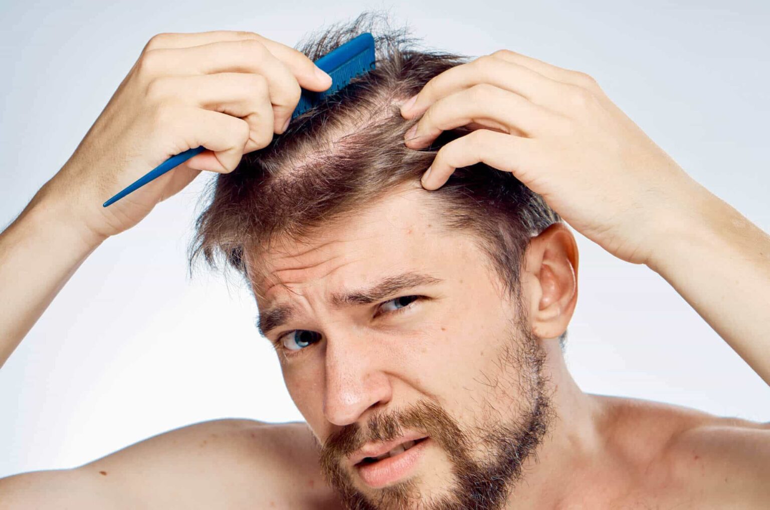 hair loss vs. hair shedding, a man with extreme hair loss