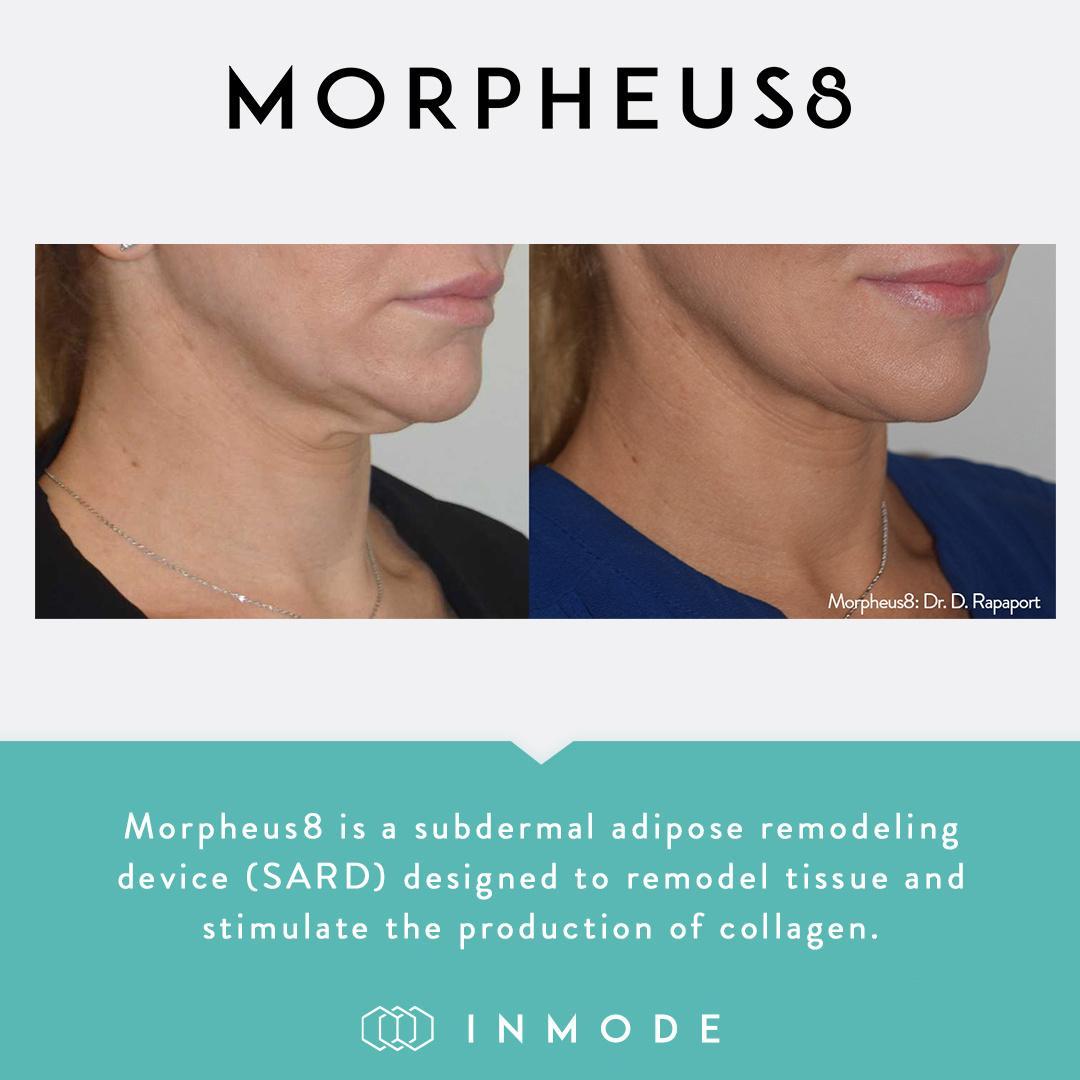 Morpheus 8: Neck | The Ferguson Clinic