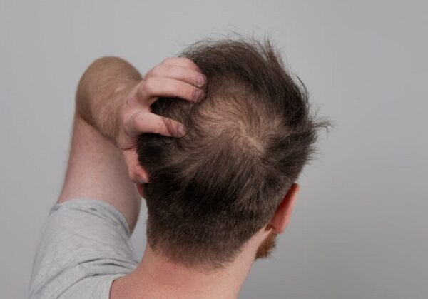 in this image the person is showing his baldness in the middle area of head. by https://renewyou.co.in/hair-patch-hair-wigs/