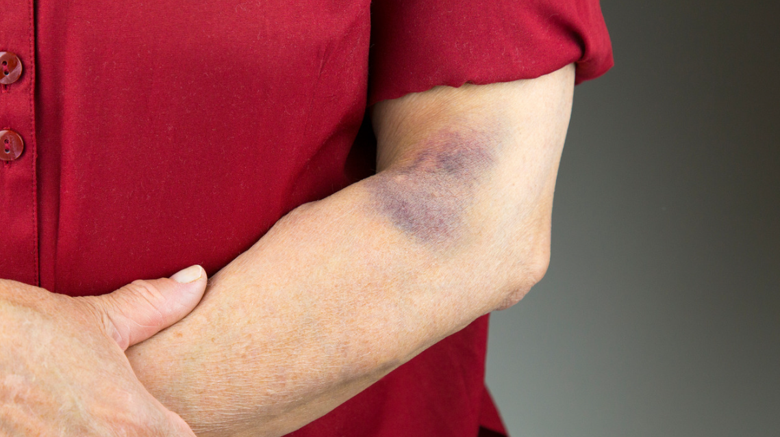 (Close-up of a person’s arm showing a visible bruise, symbolizing physical injury and potential evidence in cases of abuse or excessive force.)