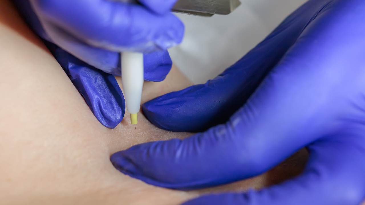 A picture of an Electrologists doing a electrolysis service on a client