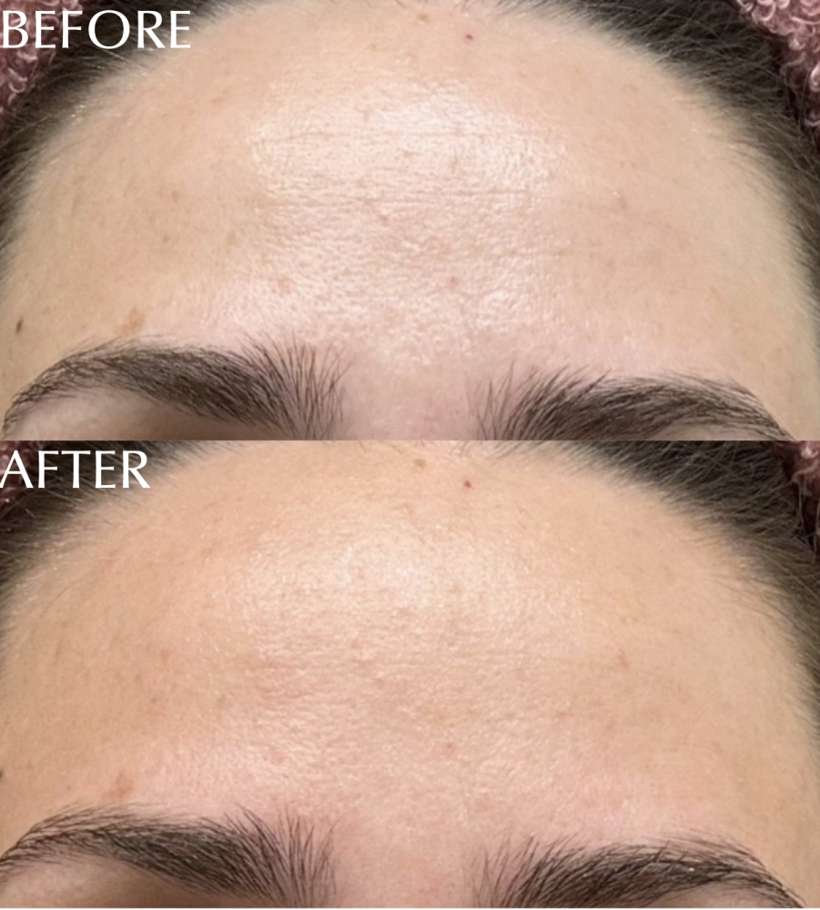 Discover the ZIIP HALO, the ultimate Botox alternative. Achieve a youthful glow and smoother skin without the needles.