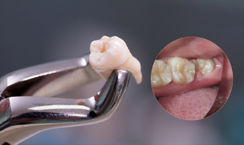 Tại Sao Phải Nhổ Răng Khôn? Giải Đáp Từ Chuyên Gia Nha Khoa