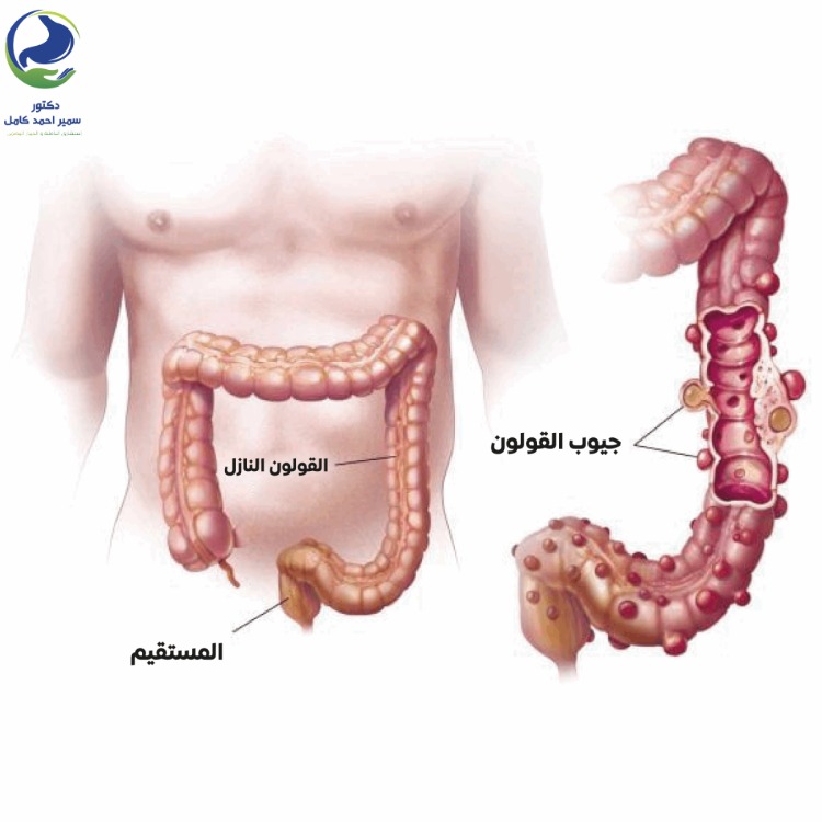 نصائح لتجنب التهاب القولون التقرحي