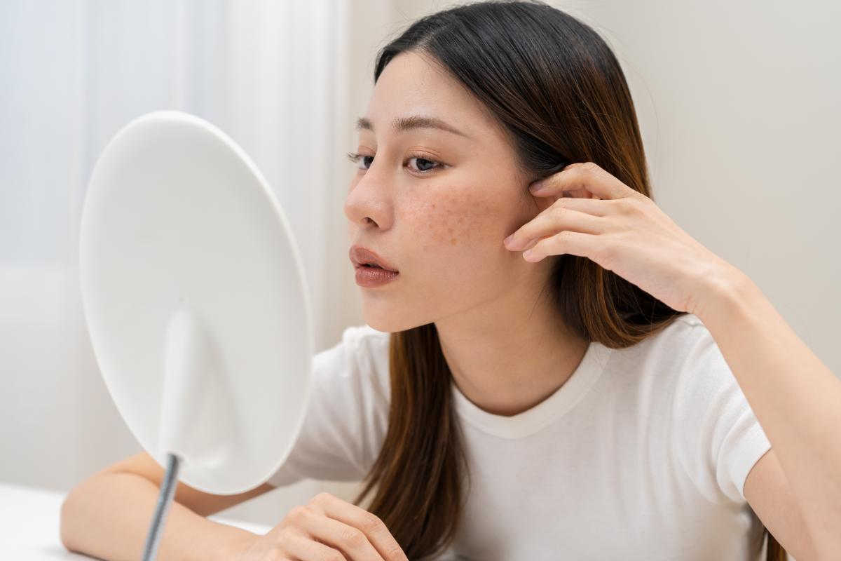 Eliminare melasma sau pete pigmentare - sfaturi pentru gestionare_femeie, oglinda, pete pigmentare 1