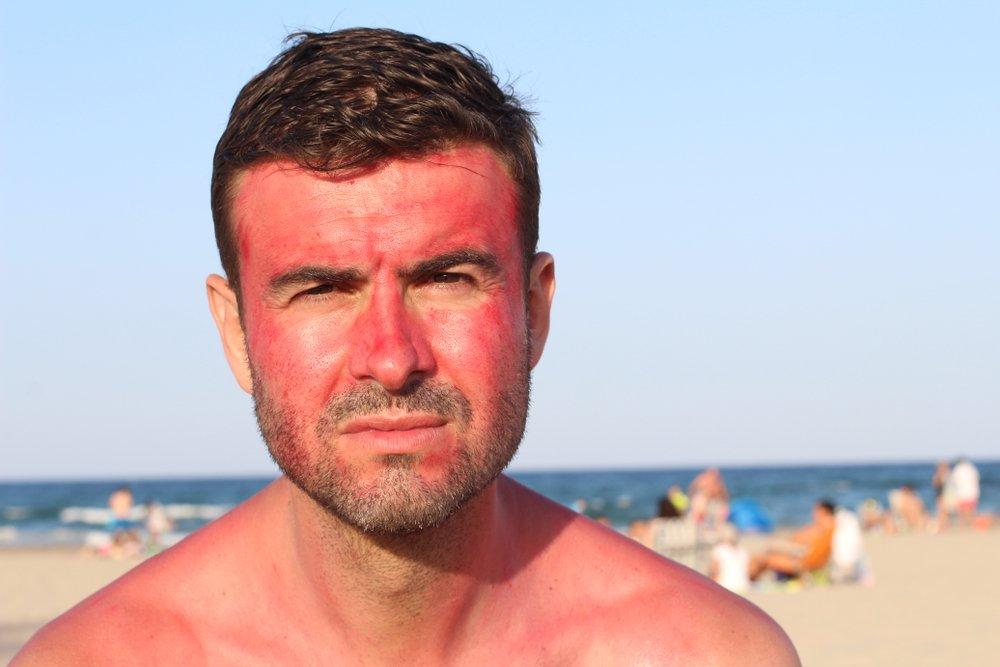 Man with severe sunburn at the beach