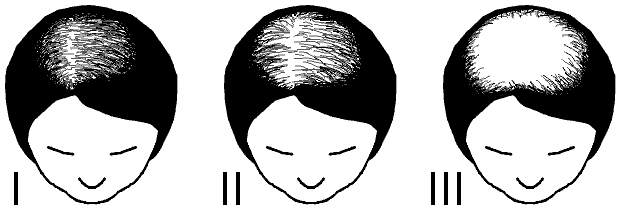 Ludwig scale stages of female hair loss