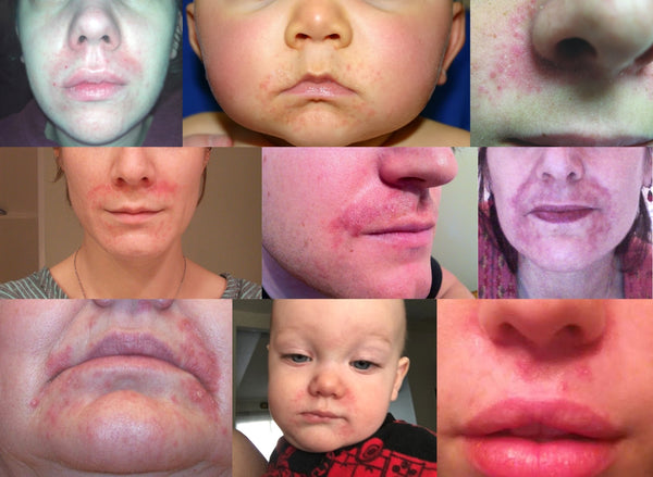 photo collage of faces with perioral dermatitis showing redness and skin irritation around noses, smile lines, and the chin