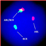 A FISH result of BCR and ABL gene fusion.