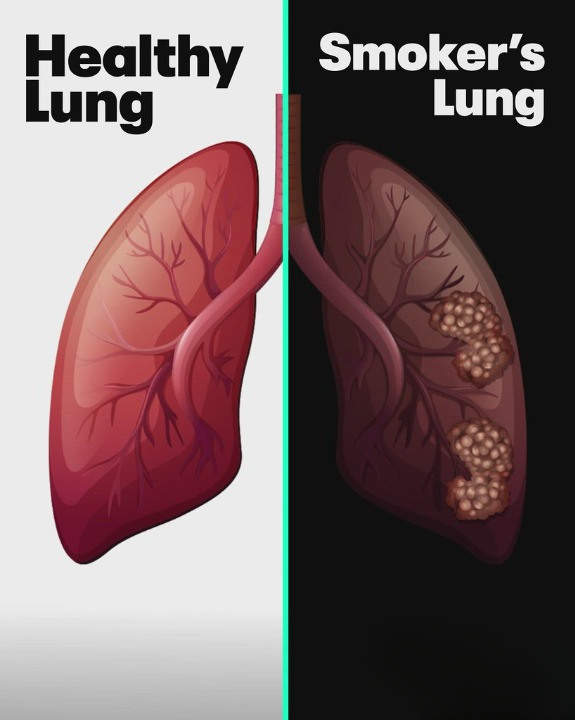 Risk Factors for Chronic Respiratory Diseases