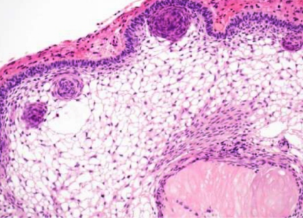 Craniopharyngioma 