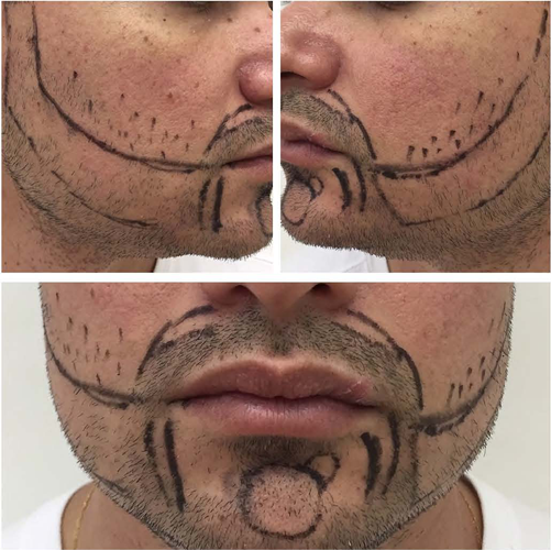 transplante de barba