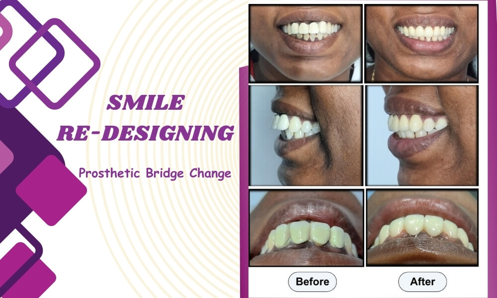 Smile Re-Designing, Prosthetic Bridge Change