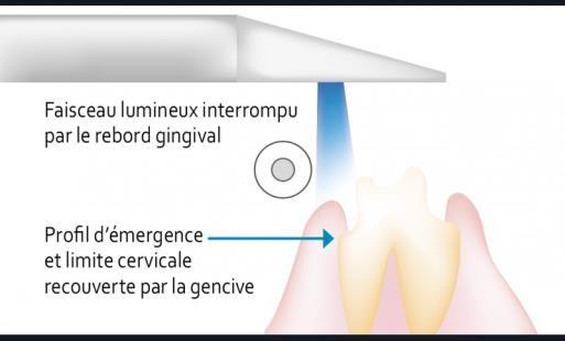 https://www.information-dentaire.fr/wp-content/thumbnails/uploads/2021/03/prise-empreinte-optique-tt-width-800-height-484-fill-1-crop-0-bgcolor-12181f-post_id-95765.png