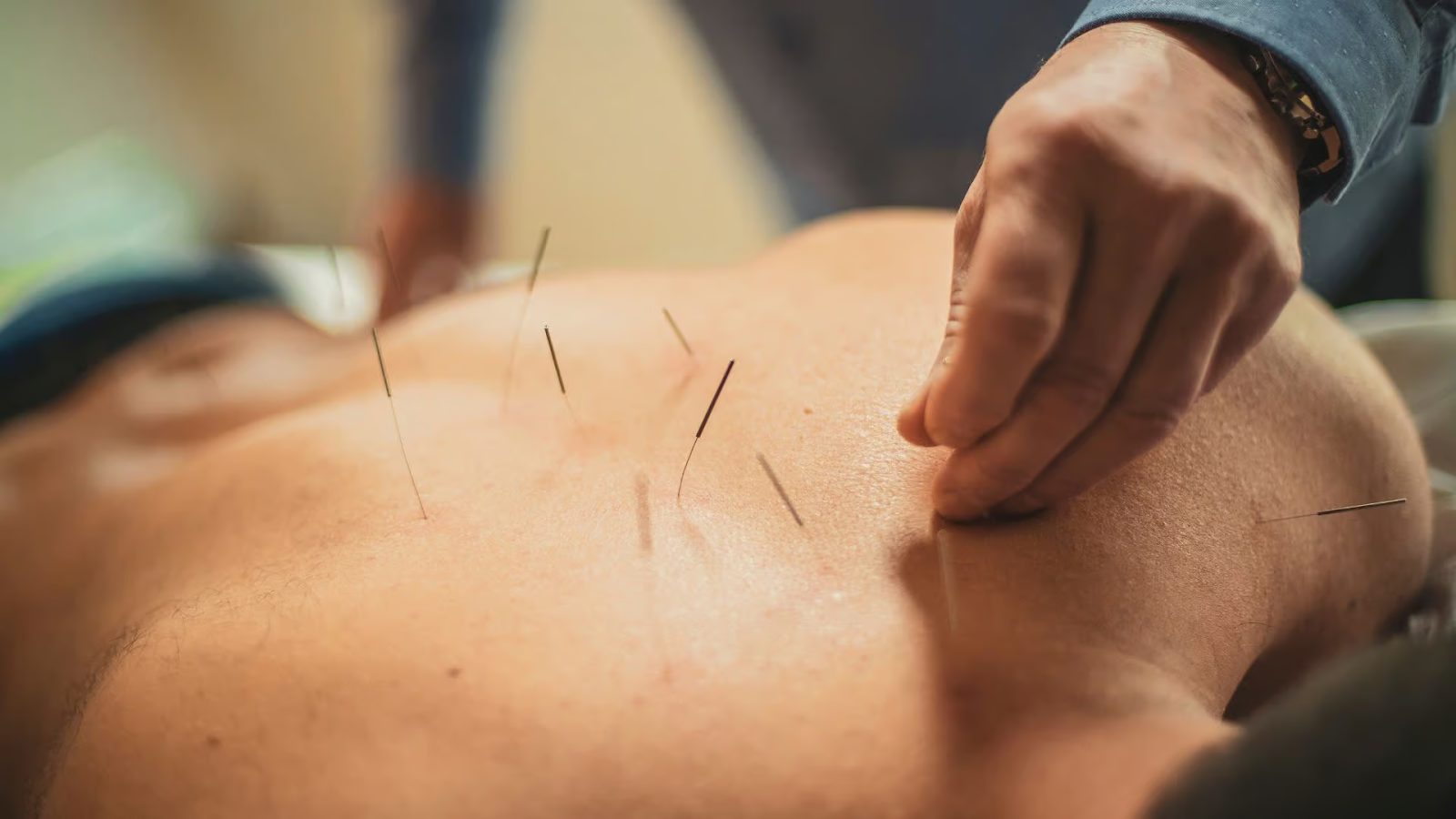 Acupuncture for Pain Relief A Natural Alternative Therapy