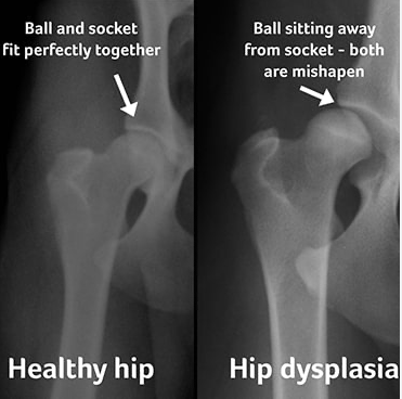 Example of a healthy hip vs a dysplastic hip