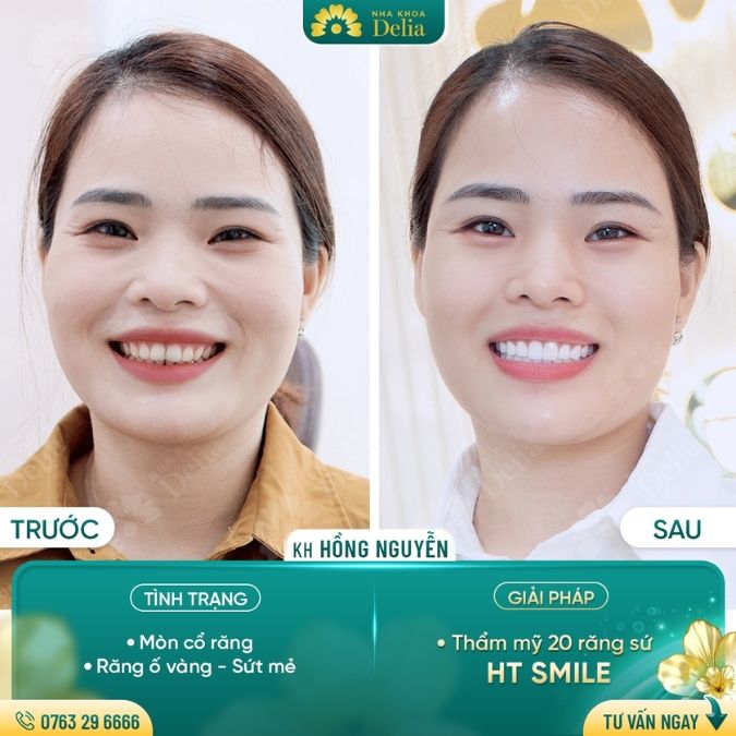 Tình trạng răng nào có thể bọc răng sứ HT Smile?