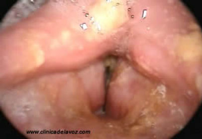 Infecciones | clinicadelavoz