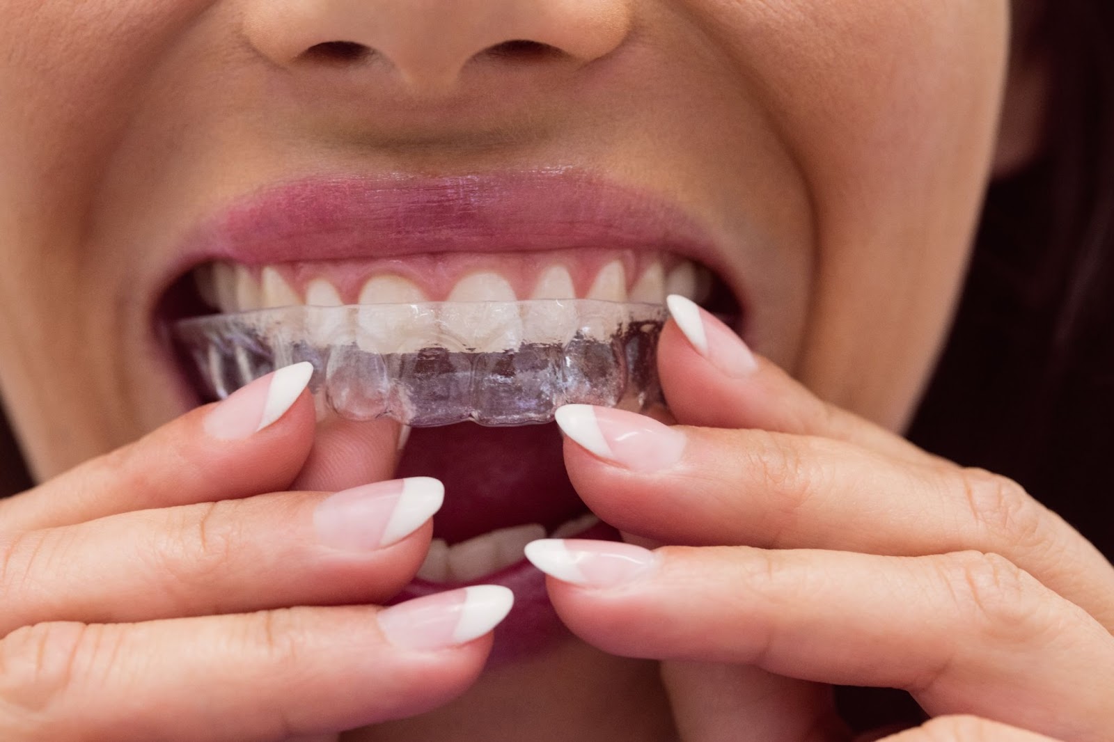 Woman inserting a clear mouthguard to protect teeth from nighttime grinding (bruxism).