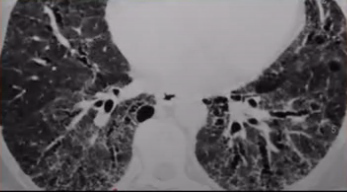 Bronchiectasis Pathology