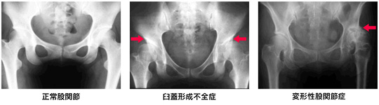 変形性股関節症とは？症状や治療法、手術後の注意点を解説