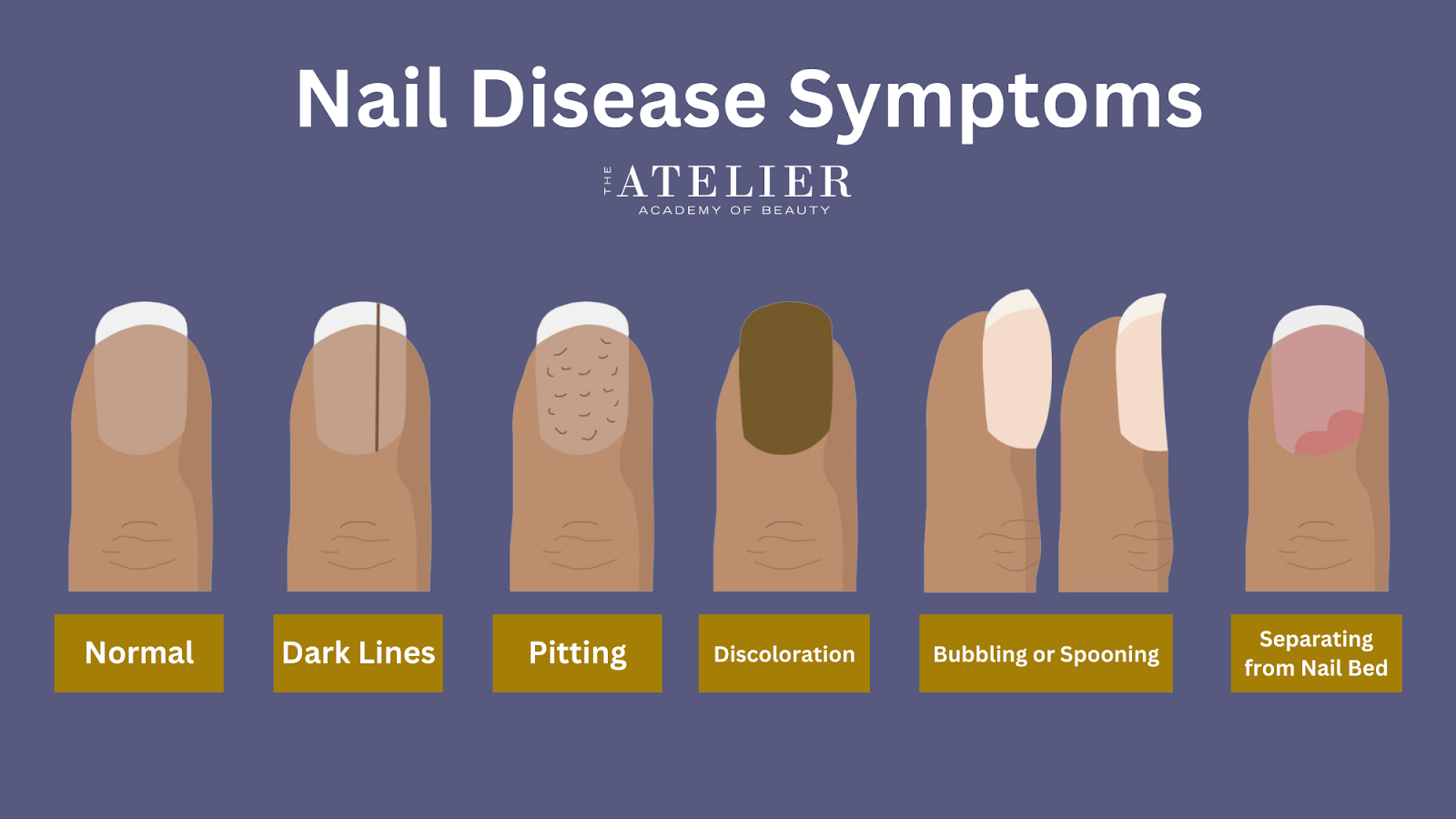 Diagram of illustrated exampled of Nail Disease Symptoms: Normal Nail, Dark Lines, Pitting, Discoloration, Bubbling or Spooning, Separating from Nail Bed