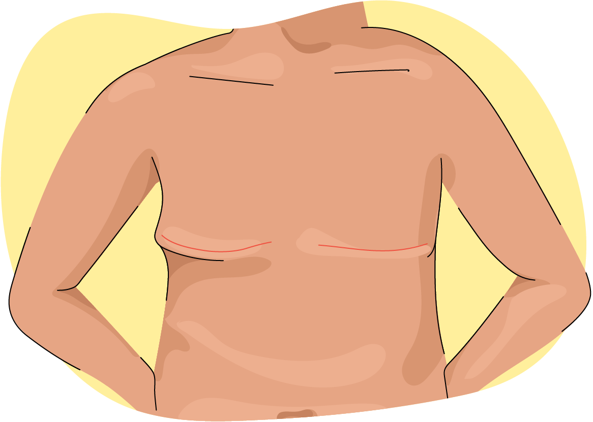 Illustration of a person with horizontal incisions across their chest after an aesthetic flat closure