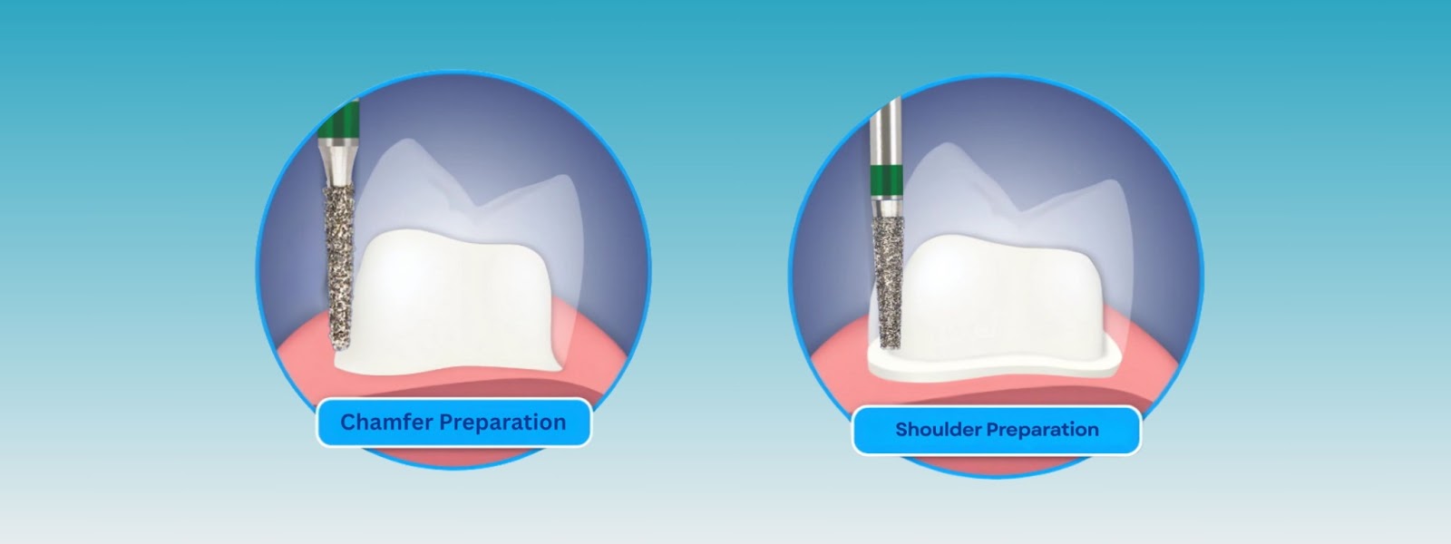 Mr. Bur Cosmetic Restorative 3-in-1 Kit FG includes burs for depth marking, reduction, margin creation, and finishing, ideal for veneers, crowns, inlays, and cosmetic restorations.