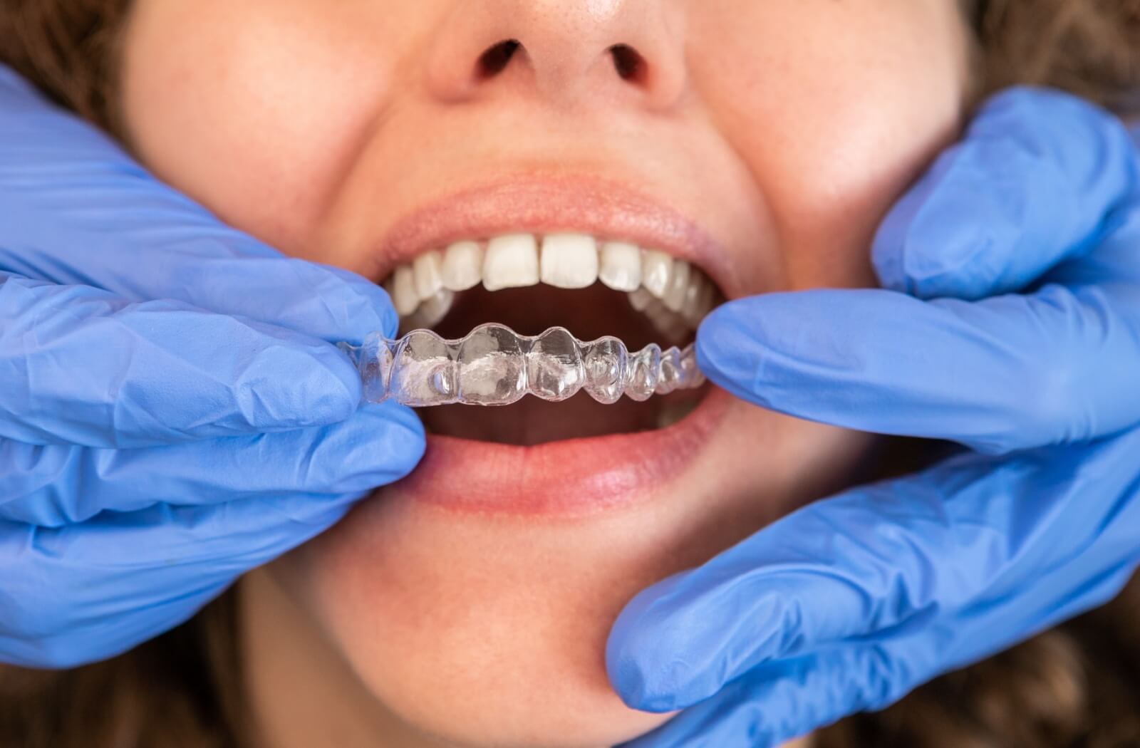 Close-up dentist hands in gloves checking the fit of an Invisalign aligner in a patient's mouth.