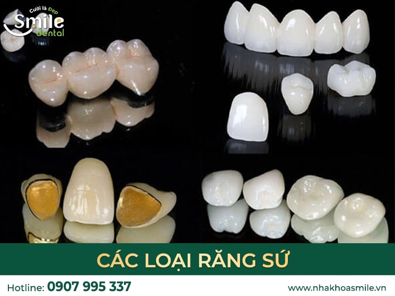 Các loại răng sứ phổ biến​