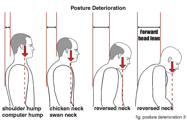 forwardhead