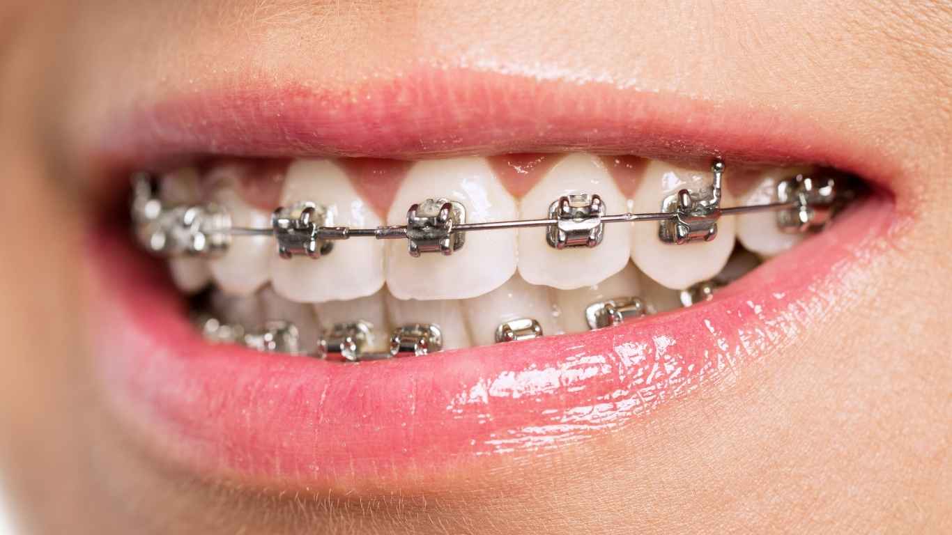 Self-Ligating Braces