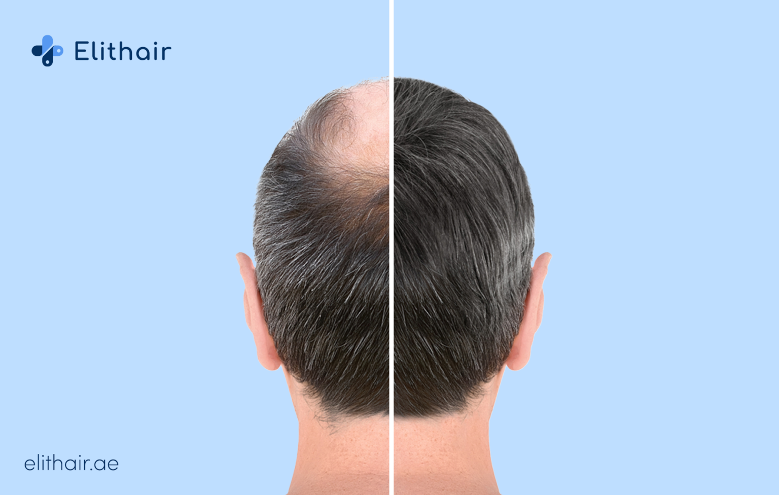زراعة الشعر في اليت هير في دبي