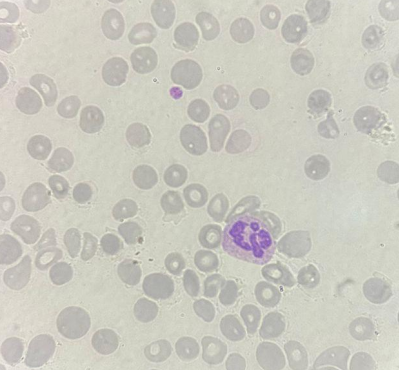 anemia aplástica