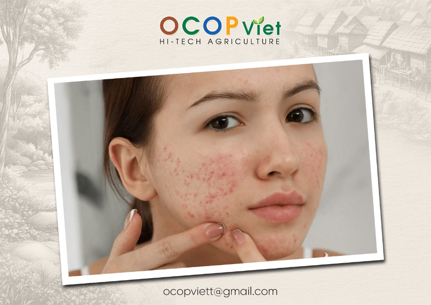 bị mụn nên ăn trái cây gì