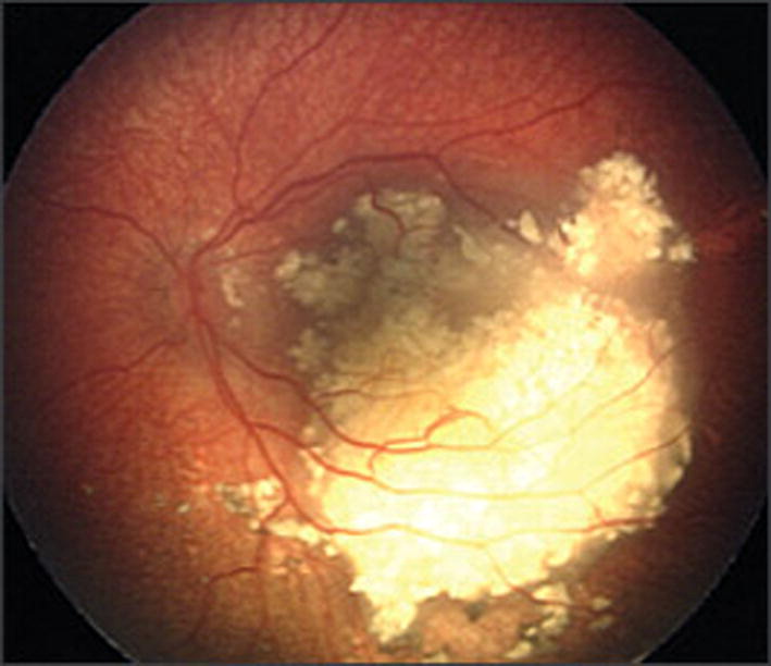 Diffuse infiltrating tumour on Ophtahlmoscopy