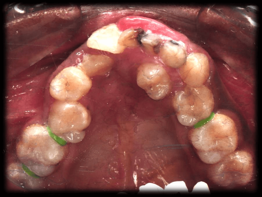 pre op occlusal ajisha