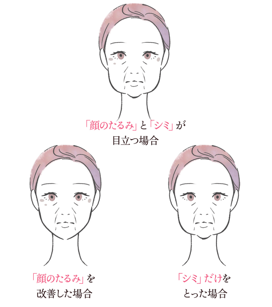 クマ・しわイメージ図４