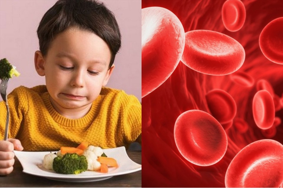 Trẻ thiếu máu do thiếu sắt mà cha mẹ không hề biết:  Thầm lặng nhưng nguy hiểm