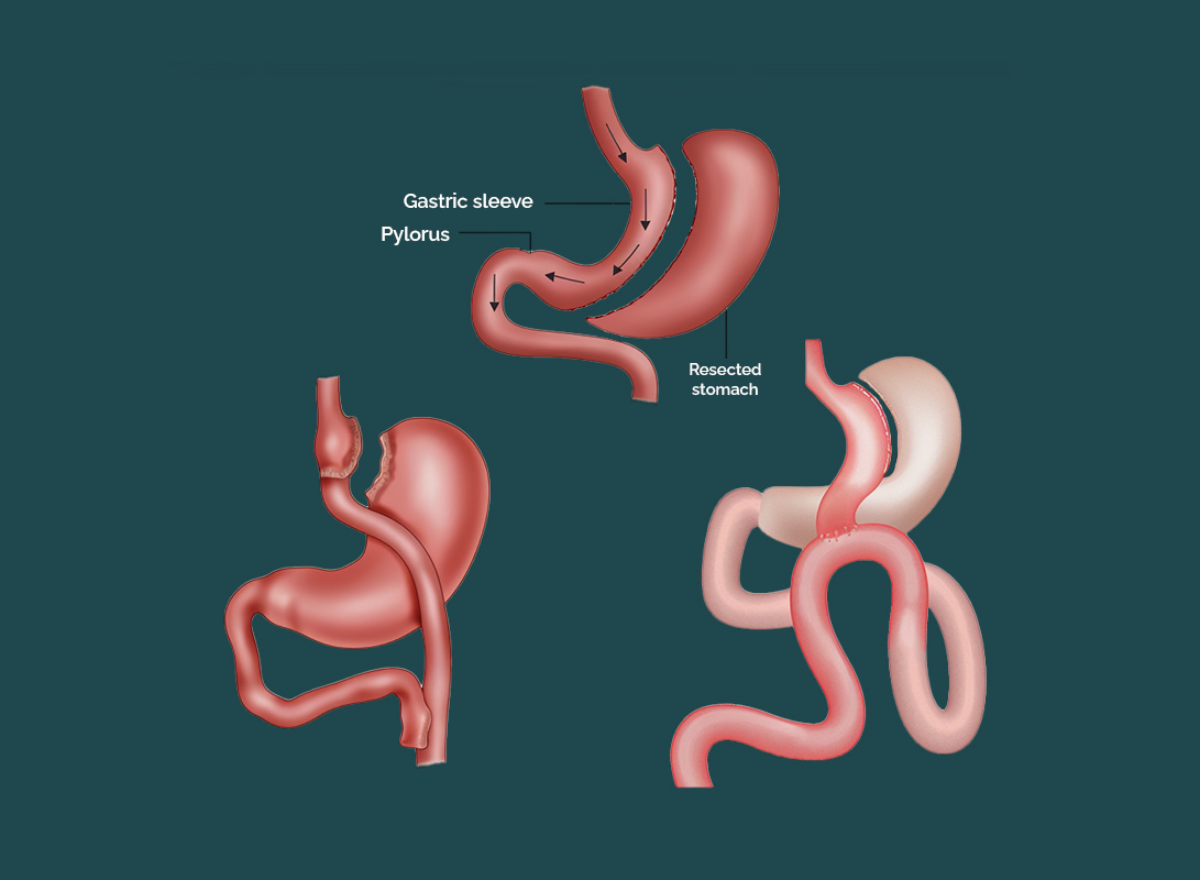 Gastric bypass surgery Procedure