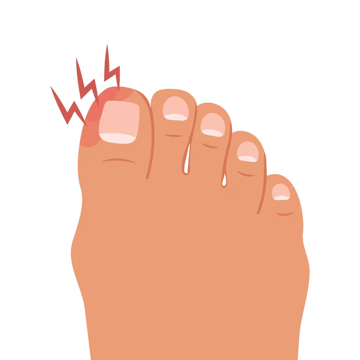 ongle incarné bleu, comment l’éviter et le soigner