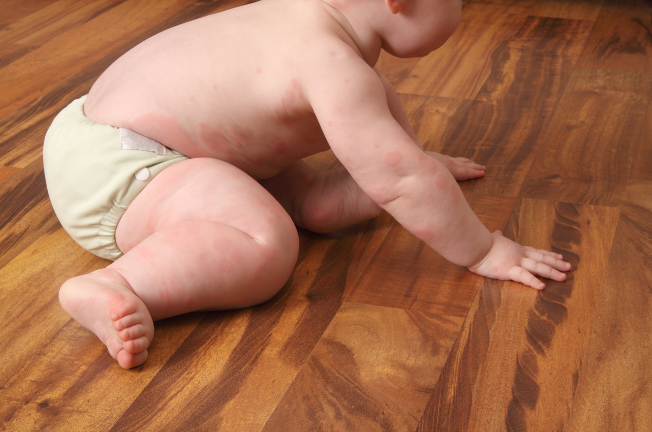 Baby with hives crawling on wooden floor // Healthier Baby Today