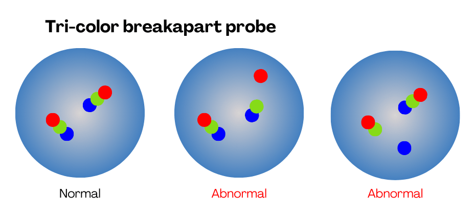 Illustration of FISH tri color break-apart probe. 