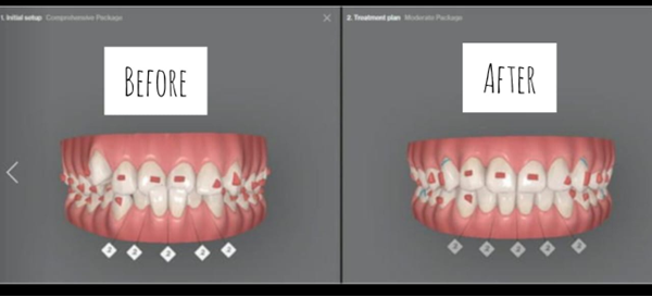 Invisalign Or Complex Restorations