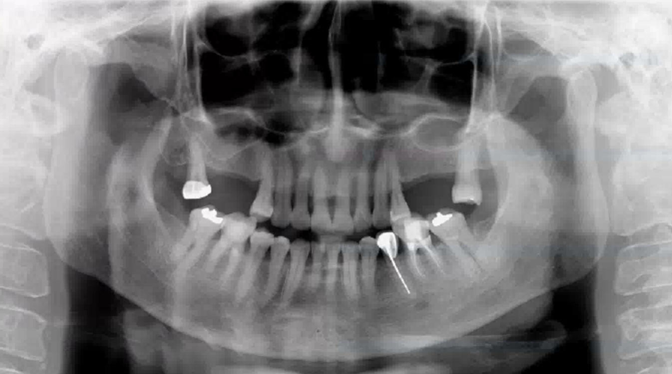 OPG X-ray