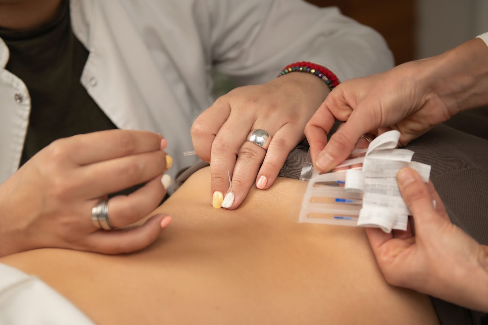 Female doctor performing acupuncture on a woman’s back. 