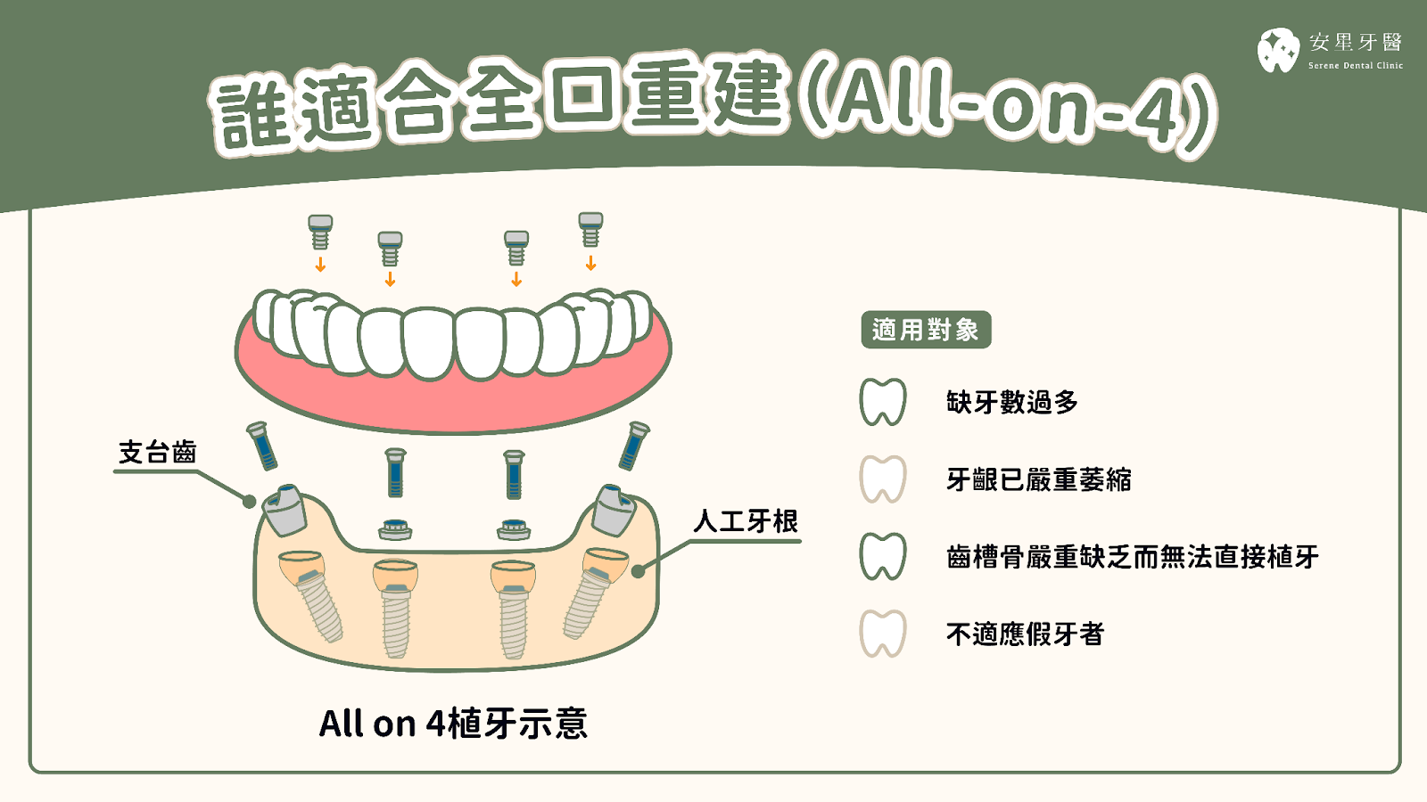 誰適合全口重建All on 4