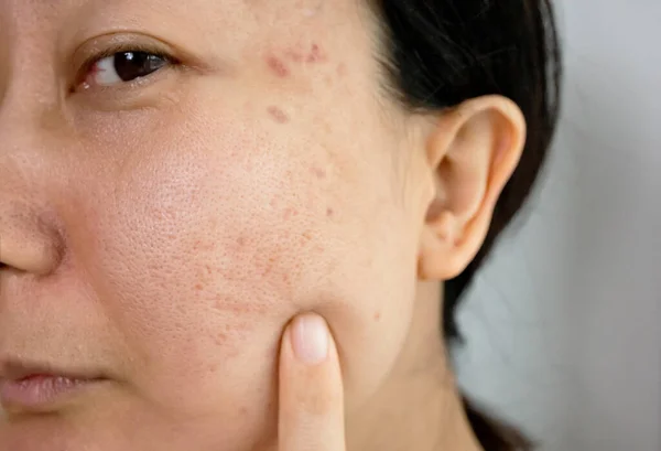 How Fillers Work to Treat Acne Scars
