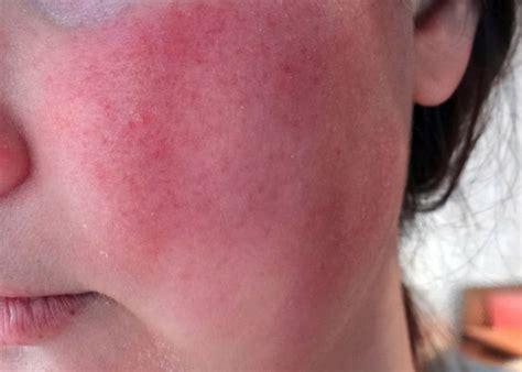 Nên sử dụng kem chống nắng để bảo vệ da dưới ánh nắng mặt trời