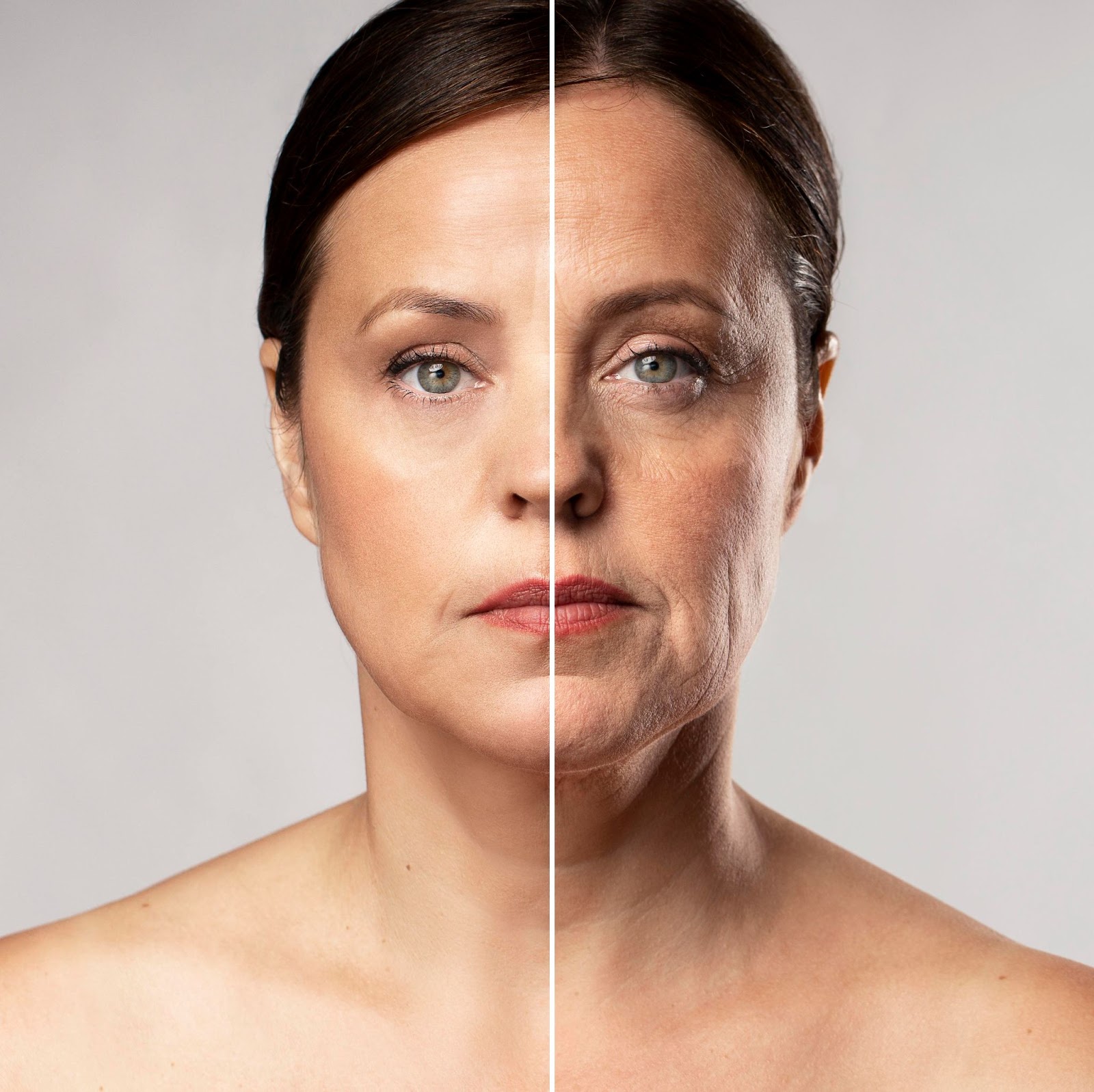 botox result